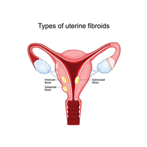 Fibroids